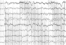 EEG Bild eines 8 jährigen Jungen im noirmalen zustand. Man sieht gleichmäßige Ausschläge.
